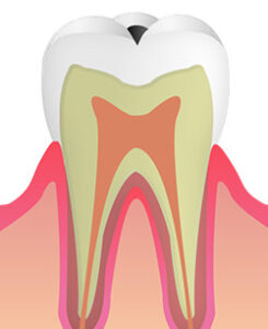 C1：エナメル質のむし歯