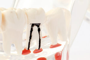 根管治療イメージ